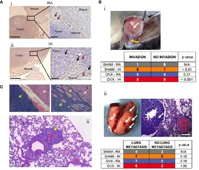 A review of obstructive sleep apnea and lung cancer: epidemiology, pathogenesis, and therapeutic options